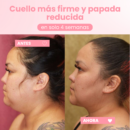 Infibella™ | Rejuvenece 10 años en 4 semanas