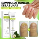 MYCARE™ ELIMINA LOS HONGOS DE LAS UÑAS EN 5 DÍAS Y EVITA QUE APEREZCAN PARA SIEMPRE
