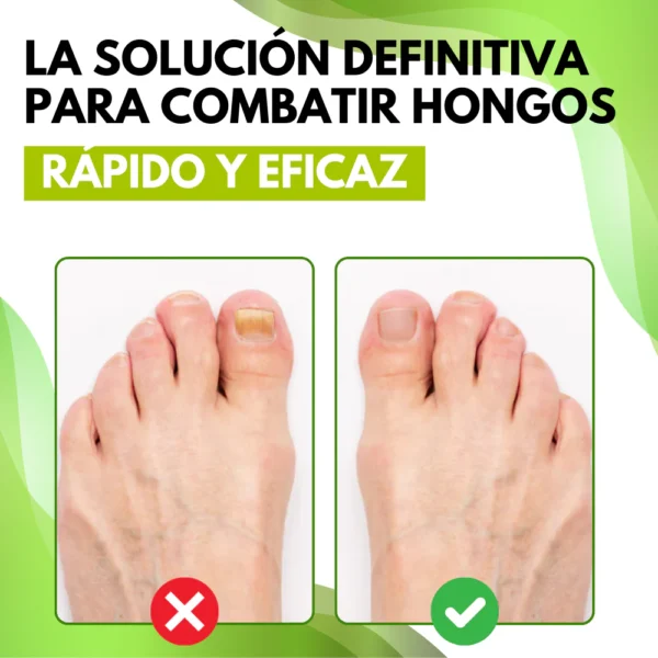 MYCARE™ ELIMINA LOS HONGOS DE LAS UÑAS EN 5 DÍAS Y EVITA QUE APEREZCAN PARA SIEMPRE - Image 3