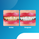 HydroSmile + Lápiz Blanqueador GRATIS